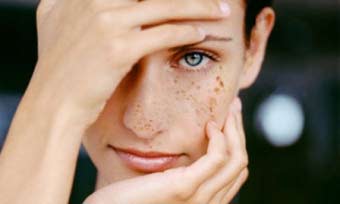 Як прибрати пігментні плями на обличчі