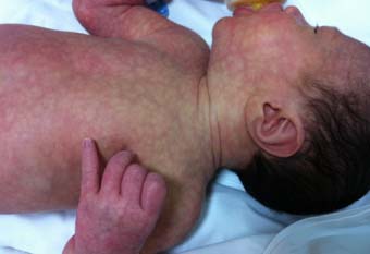 мармурова шкіра у новонародженого