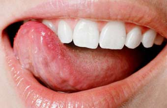 Чому виникає жовтий наліт на язиці?