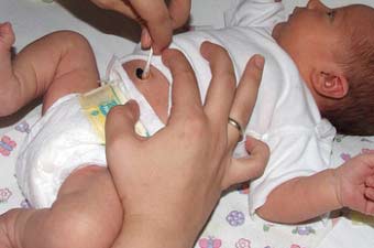 Правильна обробка пупка у новонароджених